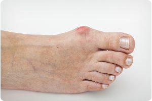 WHEN TO SEEK TREATMENT FOR BUNION PAIN