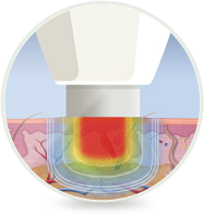 Swift Microwave Therapy - Foot Doctors of Kansas City